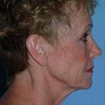 Lip Augmentation Before & After Patient #11160