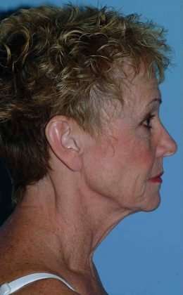 Lip Augmentation Before & After Patient #11160