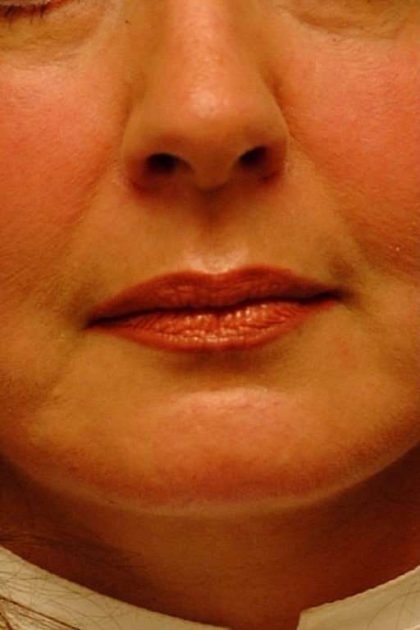 Lip Augmentation Before & After Patient #11175