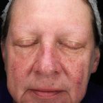 Laser Resurfacing Before & After Patient #11182