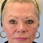 Laser Resurfacing Before & After Patient #11192