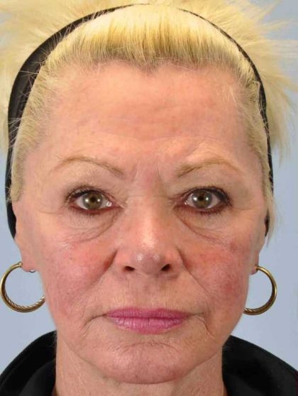 Laser Resurfacing Before & After Patient #11192