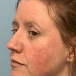 Laser Resurfacing Before & After Patient #11197