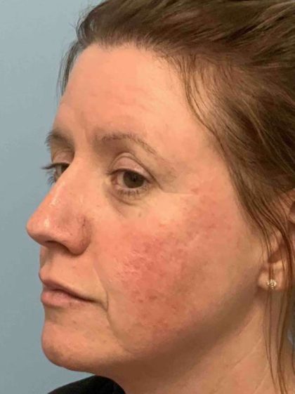 Laser Resurfacing Before & After Patient #11197