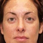 Laser Resurfacing Before & After Patient #11208