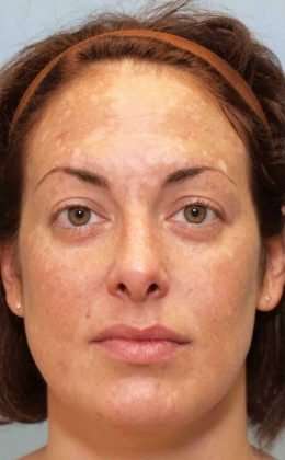 Laser Resurfacing Before & After Patient #11208