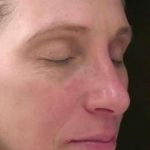 Laser Resurfacing Before & After Patient #11215