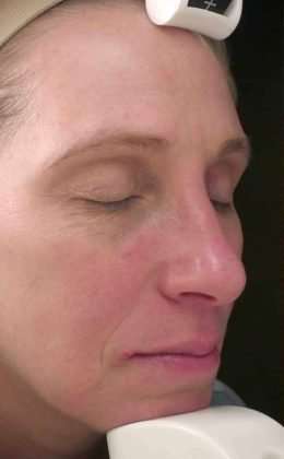 Laser Resurfacing Before & After Patient #11215