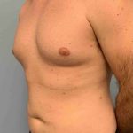 Gynecomastia Before & After Patient #11237