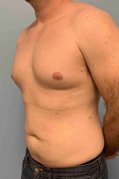 Gynecomastia Before & After Patient #11237