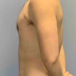 Gynecomastia Before & After Patient #11246