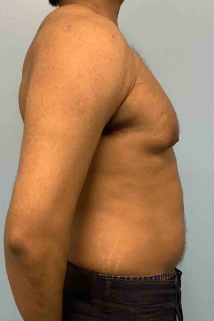 Gynecomastia Before & After Patient #11253