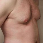 Gynecomastia Before & After Patient #11260
