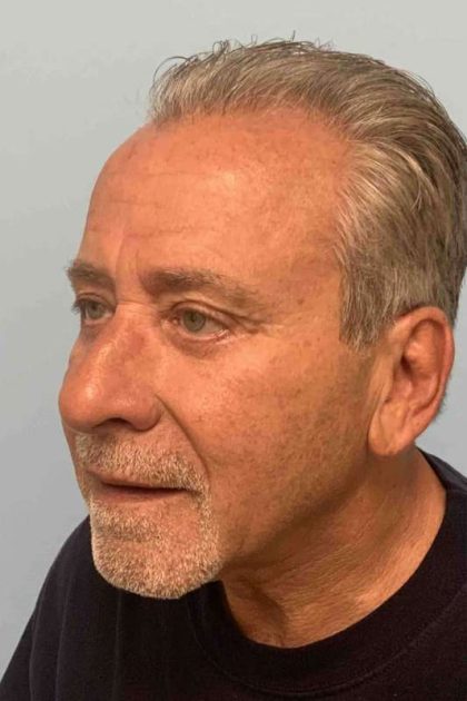 Fillers Before & After Patient #11276