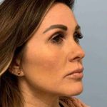 Fillers Before & After Patient #11283