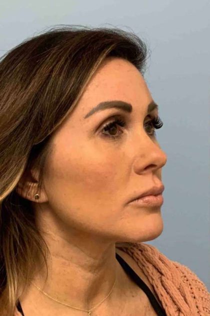 Fillers Before & After Patient #11283