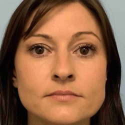 Fillers Before & After Patient #11288