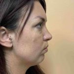 Fillers Before & After Patient #11298