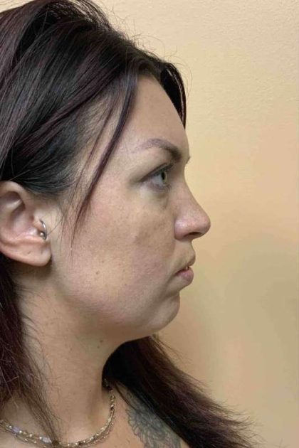 Fillers Before & After Patient #11298