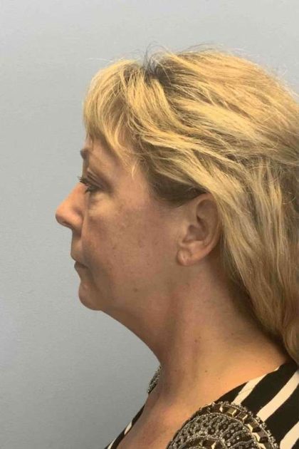 Fat Injections Before & After Patient #11305
