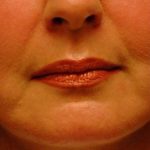 Fat Injections Before & After Patient #11326