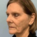Fat Injections Before & After Patient #11347