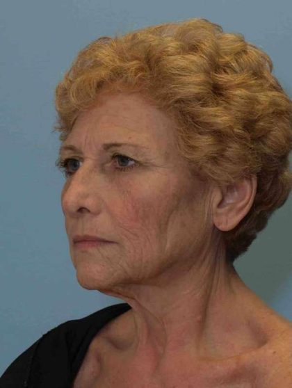 Facelift Before & After Patient #11371