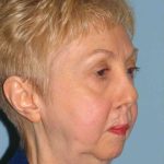 Facelift Before & After Patient #11403