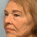 Facelift Before & After Patient #11410