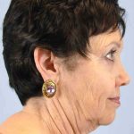 Facelift Before & After Patient #11431