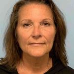 Facelift Before & After Patient #11450