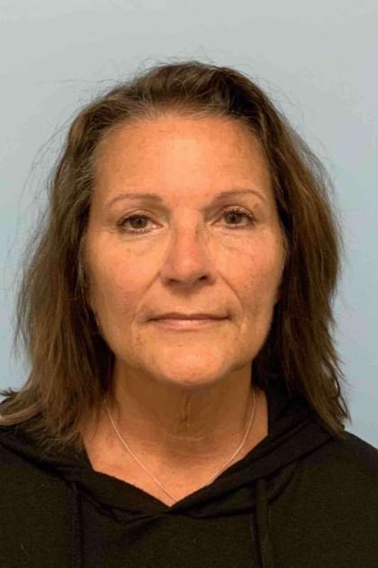 Facelift Before & After Patient #11450