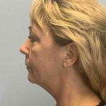 Eyelid Surgery Before & After Patient #11464