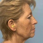 Eyelid Surgery Before & After Patient #11476