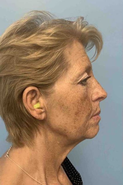 Eyelid Surgery Before & After Patient #11476