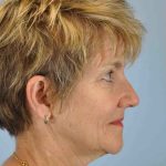 Eyelid Surgery Before & After Patient #11483