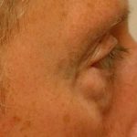 Eyelid Surgery Before & After Patient #11497