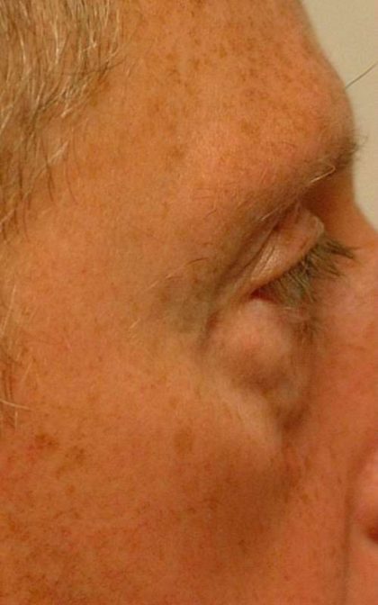 Eyelid Surgery Before & After Patient #11497