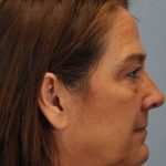 Eyelid Surgery Before & After Patient #11504