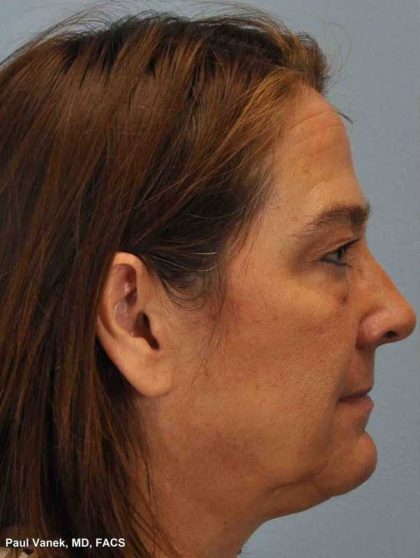 Eyelid Surgery Before & After Patient #11504
