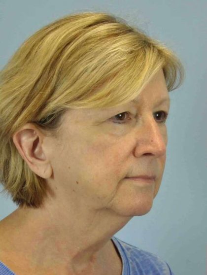 Eyelid Surgery Before & After Patient #11511