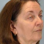 Eyelid Surgery Before & After Patient #11518