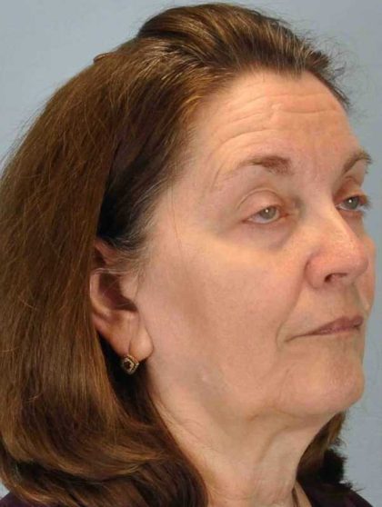 Eyelid Surgery Before & After Patient #11518
