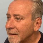 Eyelid Surgery Before & After Patient #11525