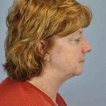 Eyelid Surgery Before & After Patient #11565