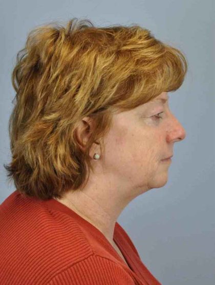 Eyelid Surgery Before & After Patient #11565