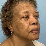Eyelid Surgery Before & After Patient #11603