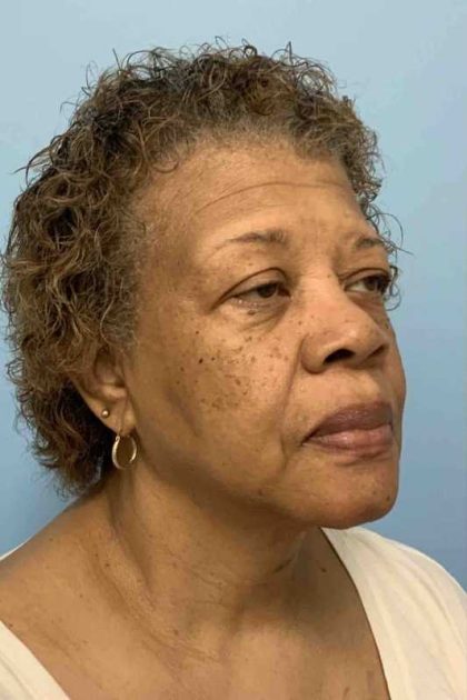 Eyelid Surgery Before & After Patient #11603