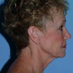 Eyelid Surgery Before & After Patient #11624