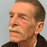 Eyelid Surgery Before & After Patient #11631